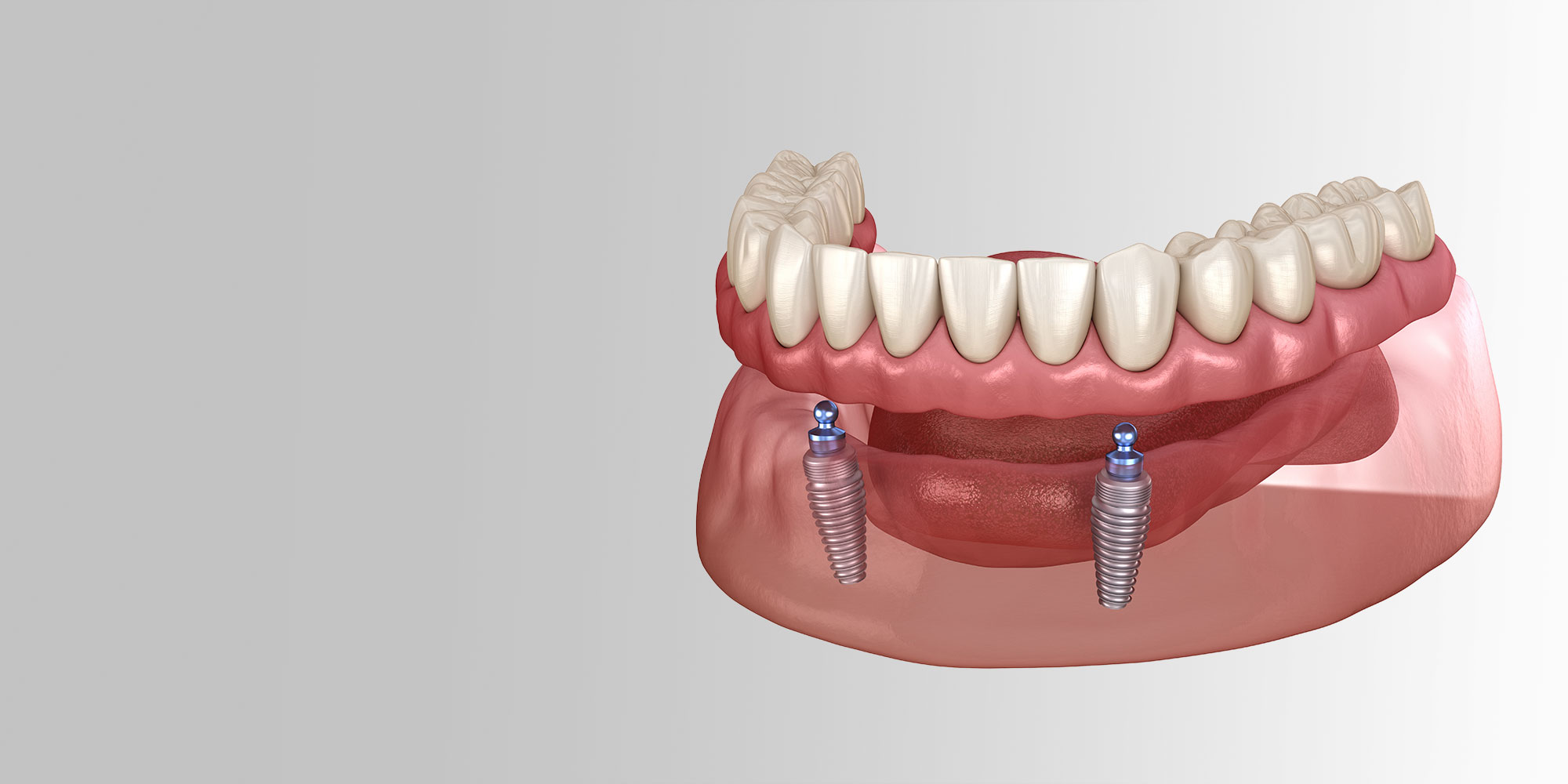 implants supported denture