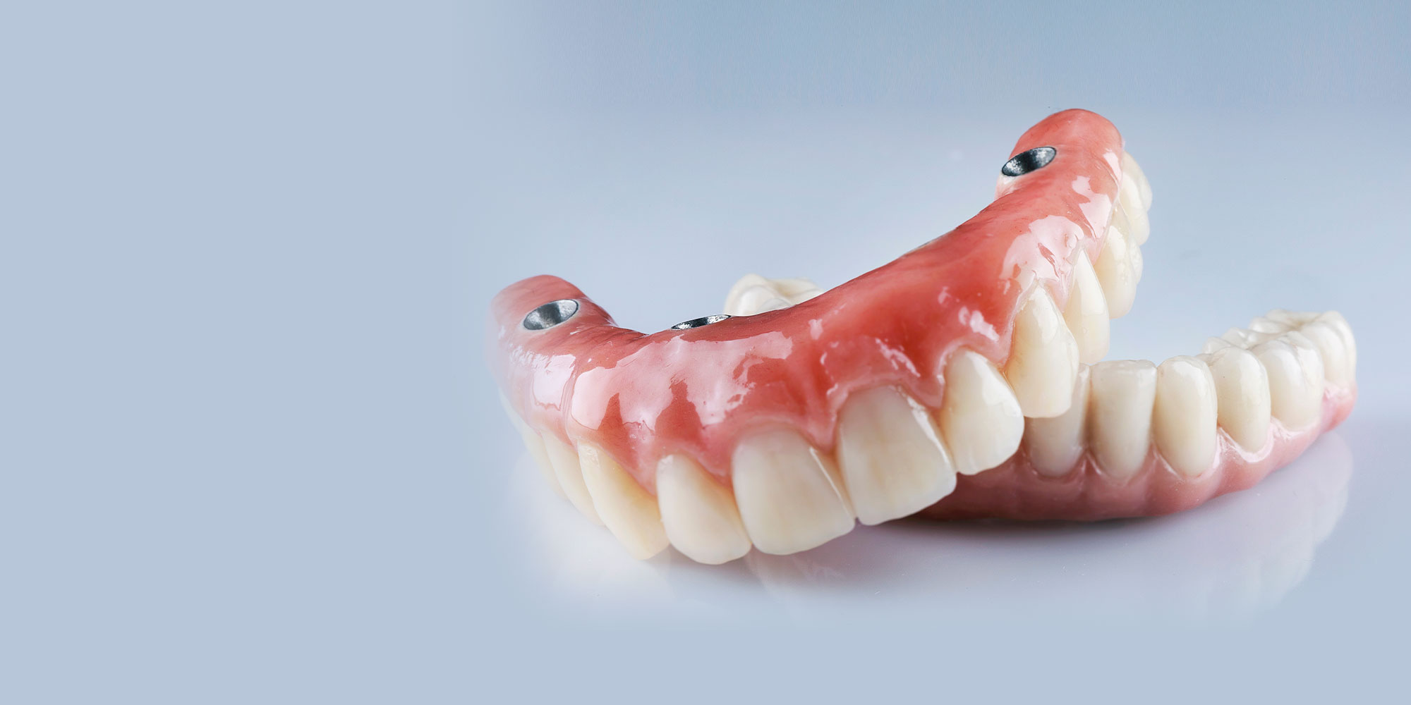 full arch dental implants